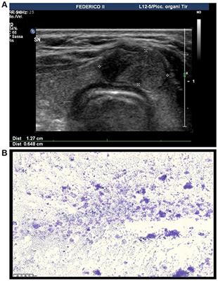 Is the Isthmus Location an Additional Risk Factor for Indeterminate Thyroid Nodules? Case Report and Review of the Literature